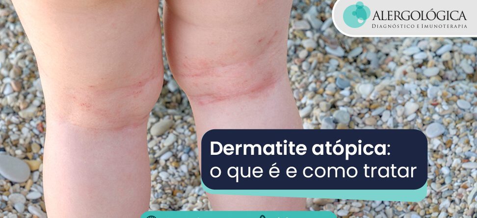 Alergologica - Blog - Dermatite Atopica