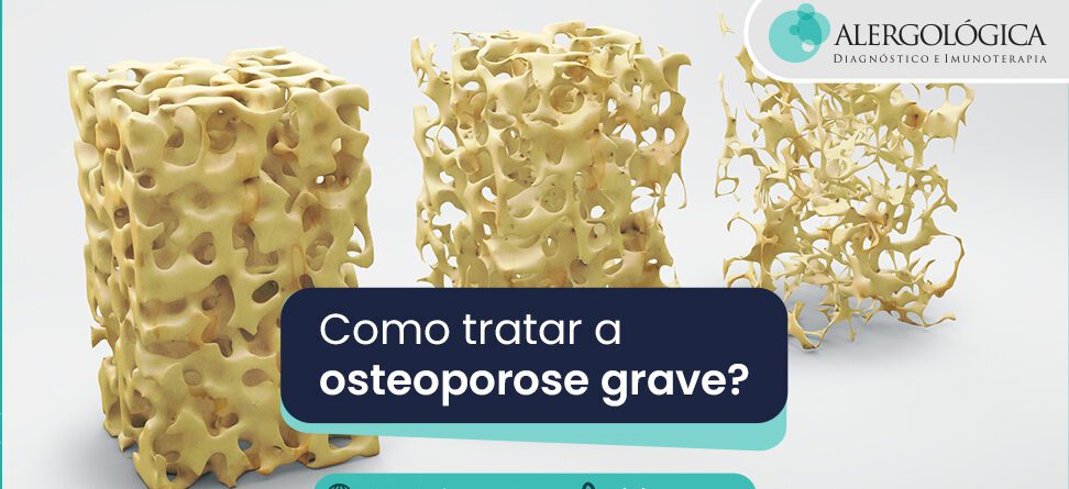Alergologica - Blog_Osteoporose grave como tratar