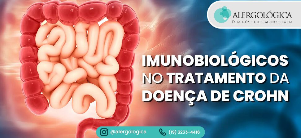 Alergologica - Imunobiológicos no tratamento da doença de Crohn