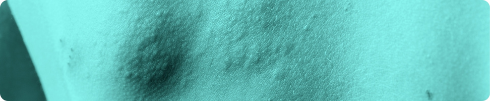 Clinica Alergologica - Blog - Urticaria e Urticaria Cronica - imagens internas (1)