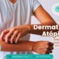 ALERGOLÓGICA - blog - dermatite atopica - capa
