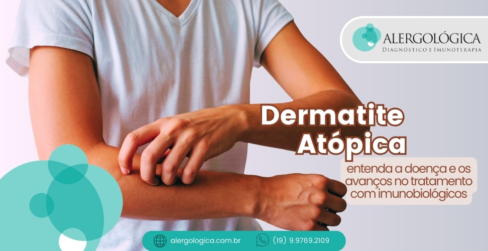 ALERGOLÓGICA - blog - dermatite atopica - capa